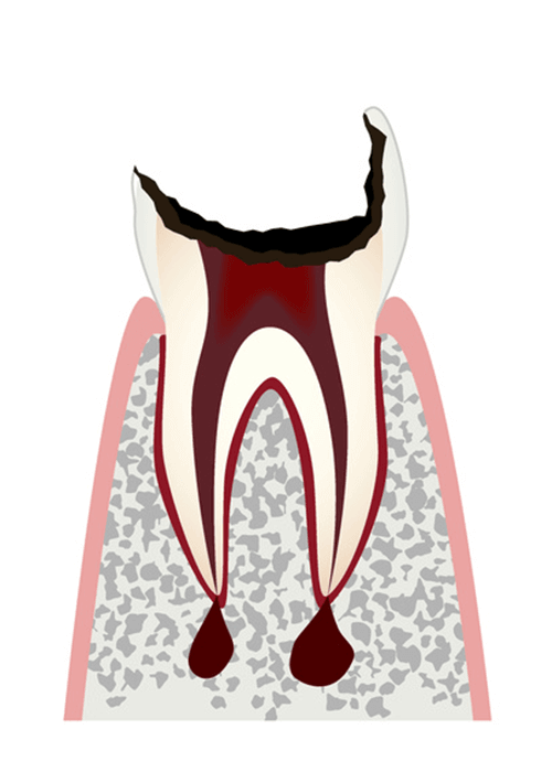歯冠部歯質が失われた歯